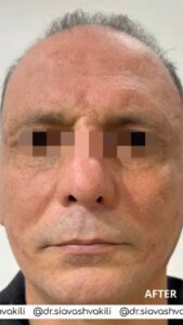 نمونه کار لیفت با نخ (دکتر سیاوش وکیلی)
