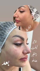 نمونه کار هایفوتراپی (کلینیک لاغری طراوت)