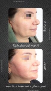 نمونه کار لیفت با نخ (دکتر سیاوش وکیلی)