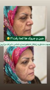 نمونه کار هایفوتراپی (کلینیک لاغری طراوت)