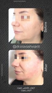 نمونه کار لیفت با نخ (دکتر سیاوش وکیلی)