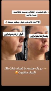 نمونه کار هایفوتراپی (کلینیک لاغری طراوت)