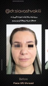 نمونه کار لیفت با نخ (دکتر سیاوش وکیلی)