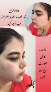 نمونه کار هایفوتراپی (کلینیک لاغری طراوت)