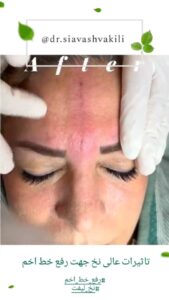 نمونه کار لیفت با نخ (دکتر سیاوش وکیلی)