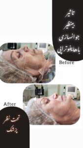 نمونه کار هایفوتراپی (کلینیک لاغری طراوت)