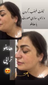 نمونه کار هایفوتراپی (کلینیک لاغری طراوت)