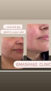 نمونه کار هایفوتراپی (کلینیک لاغری طراوت)