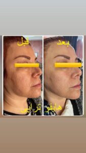 نمونه کار هایفوتراپی (کلینیک لاغری طراوت)