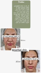 نمونه کار هایفوتراپی (کلینیک لاغری طراوت)