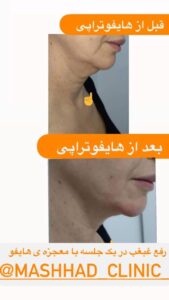 نمونه کار هایفوتراپی (کلینیک لاغری طراوت)