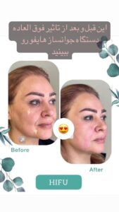 نمونه کار هایفوتراپی (کلینیک لاغری طراوت)