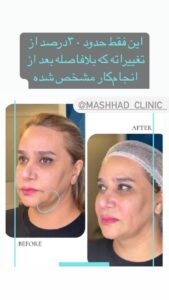 نمونه کار هایفوتراپی (کلینیک لاغری طراوت)