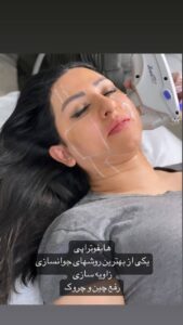 نمونه کار هایفوتراپی (کلینیک لاغری طراوت)