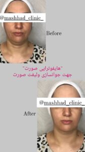 نمونه کار هایفوتراپی (کلینیک لاغری طراوت)