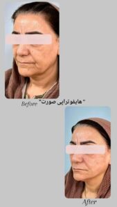 نمونه کار هایفوتراپی (کلینیک لاغری طراوت)
