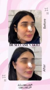 نمونه کار لیفت با نخ (دکتر سیاوش وکیلی)