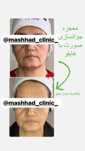 نمونه کار هایفوتراپی (کلینیک لاغری طراوت)