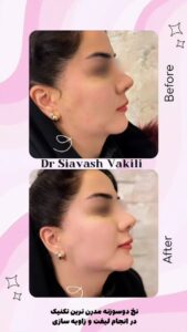 نمونه کار لیفت با نخ (دکتر سیاوش وکیلی)