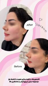 نمونه کار لیفت با نخ (دکتر سیاوش وکیلی)