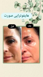 نمونه کار هایفوتراپی (کلینیک لاغری طراوت)
