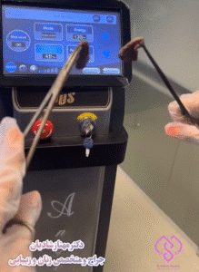 نمونه عمل لابیاپلاستی دکتر مهناز شادیان