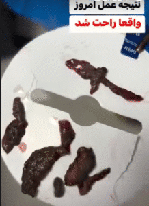 نمونه عمل لابیاپلاستی دکتر مهناز شادیان