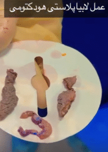 نمونه عمل لابیاپلاستی دکتر مهناز شادیان