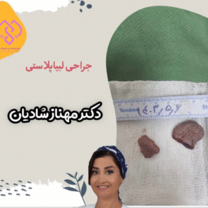 نمونه عمل لابیاپلاستی دکتر مهناز شادیان