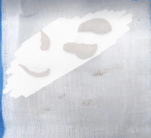 نمونه عمل لابیاپلاستی دکتر سحر محمدی