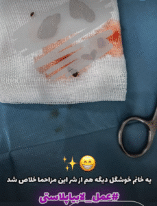نمونه عمل لابیاپلاستی دکتر سحر محمدی