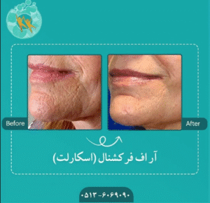 نمونه میکرونیدلینگ به روش آر اف فرکشنال کلینیک سلامت ایده ال