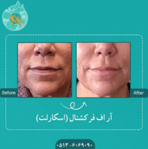نمونه میکرونیدلینگ به روش آر اف فرکشنال کلینیک سلامت ایده ال