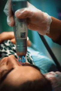 نمونه میکرونیدلینگ به روش آر اف فرکشنال کلینیک سلامت ایده ال