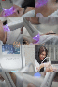 نمونه میکرونیدلینگ به روش آر اف ویرچو کلینیک سلامت ایده ال
