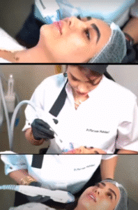 نمونه میکرونیدلینگ به روش آر اف ویرچو کلینیک سلامت ایده ال