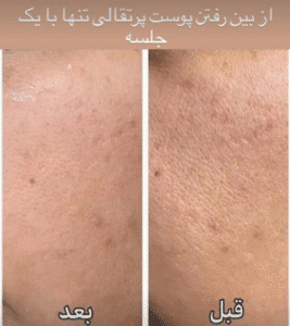 نمونه میکرونیدلینگ کلینیک سایه