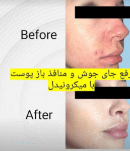 نمونه میکرونیدلینگ کلینیک سایه