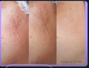 نمونه میکرونیدلینگ کلینیک سایه