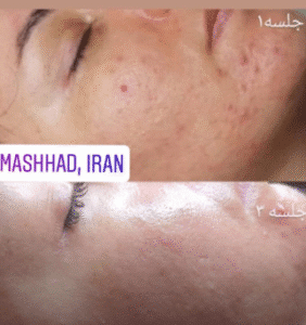 نمونه میکرونیدلینگ کلینیک سایه