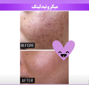 نمونه میکرونیدلینگ کلینیک سایه