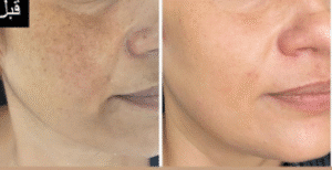 نمونه میکرونیدلینگ کلینیک سایه