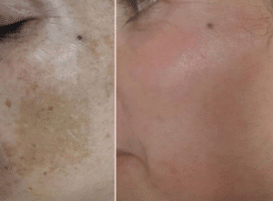 نمونه میکرونیدلینگ کلینیک سایه