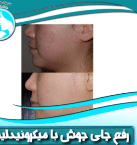 نمونه میکرونیدلینگ کلینیک پرنیان