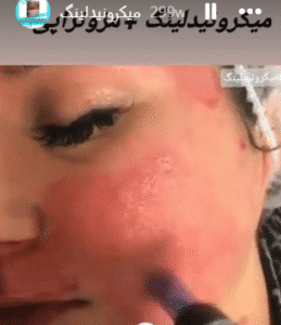 نمونه میکرونیدلینگ کلینیک پرنیان