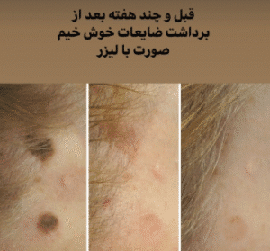 نمونه برداشتن خال دکتر محمد ایمانی