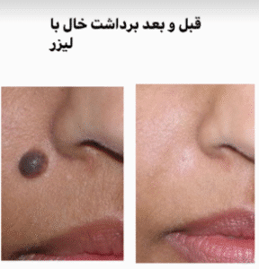 نمونه برداشتن خال دکتر محمد ایمانی