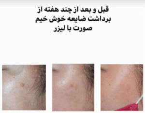 نمونه برداشتن خال دکتر محمد ایمانی