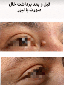 نمونه برداشتن خال دکتر محمد ایمانی
