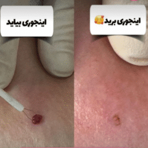 نمونه برداشتن خال کلینیک زیبایی بهاران